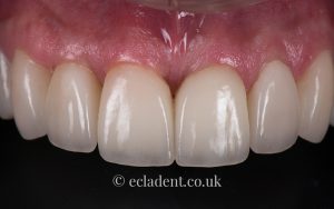 Dental Crowns and Veneers