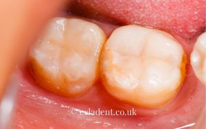 Composite Fillings