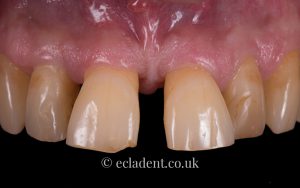 Dental Crowns and Veneers